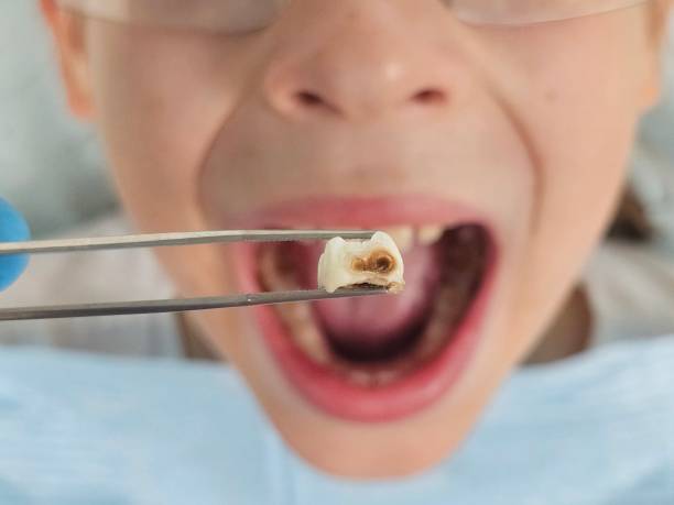Best Emergency Treatment for Toothache in Mount Vernon, IA
